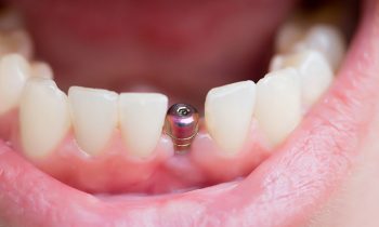dental implants Dallas