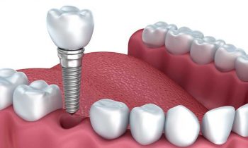 Texas Dental Implant