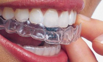 Invisalign-Dentist