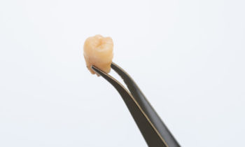 Tooth Extraction